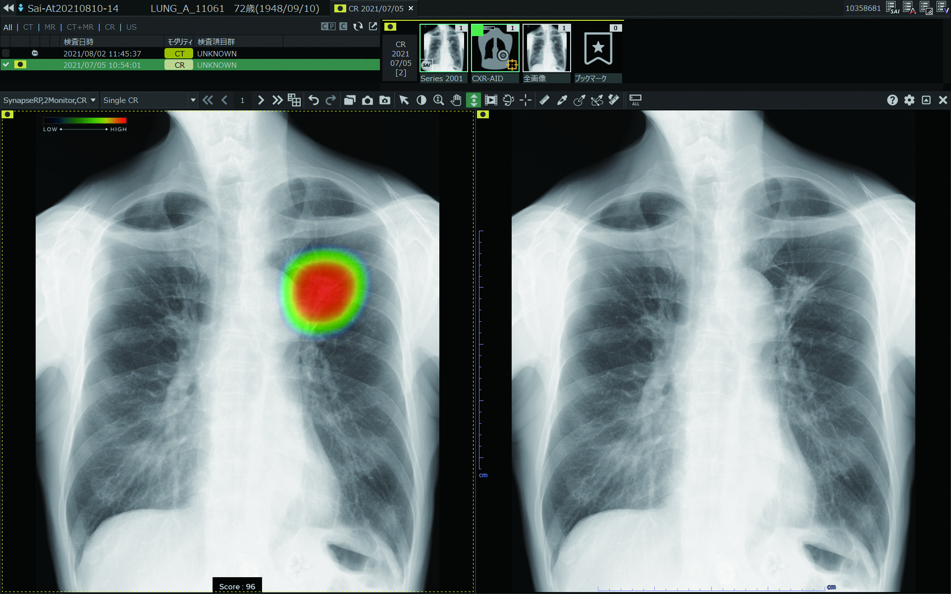 CXR-AID